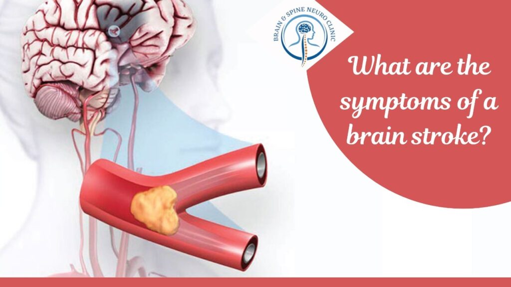 What are the symptoms of a brain stroke?DRCHIRAGGUPTA